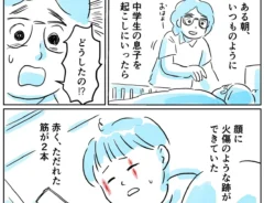 やけど虫の注意喚起のエッセイ漫画